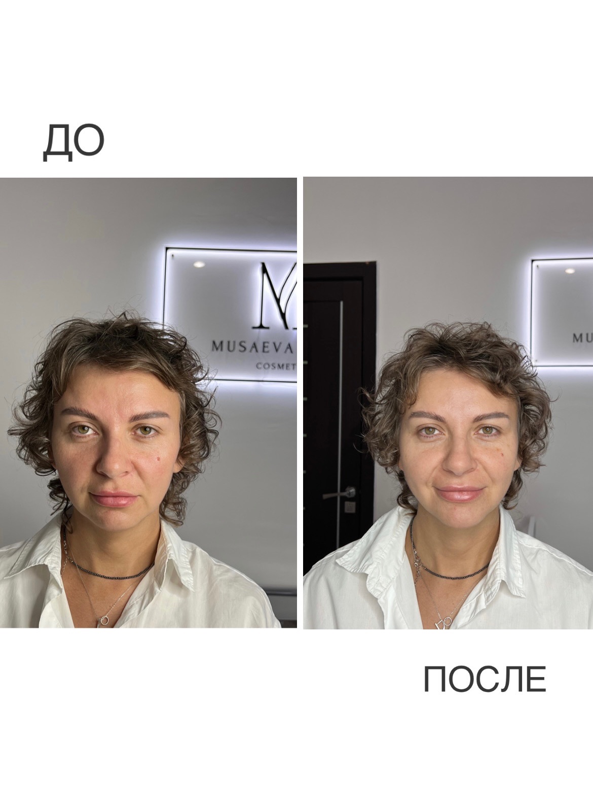 До и после процедуры в Мусаевы PROFI Балашов