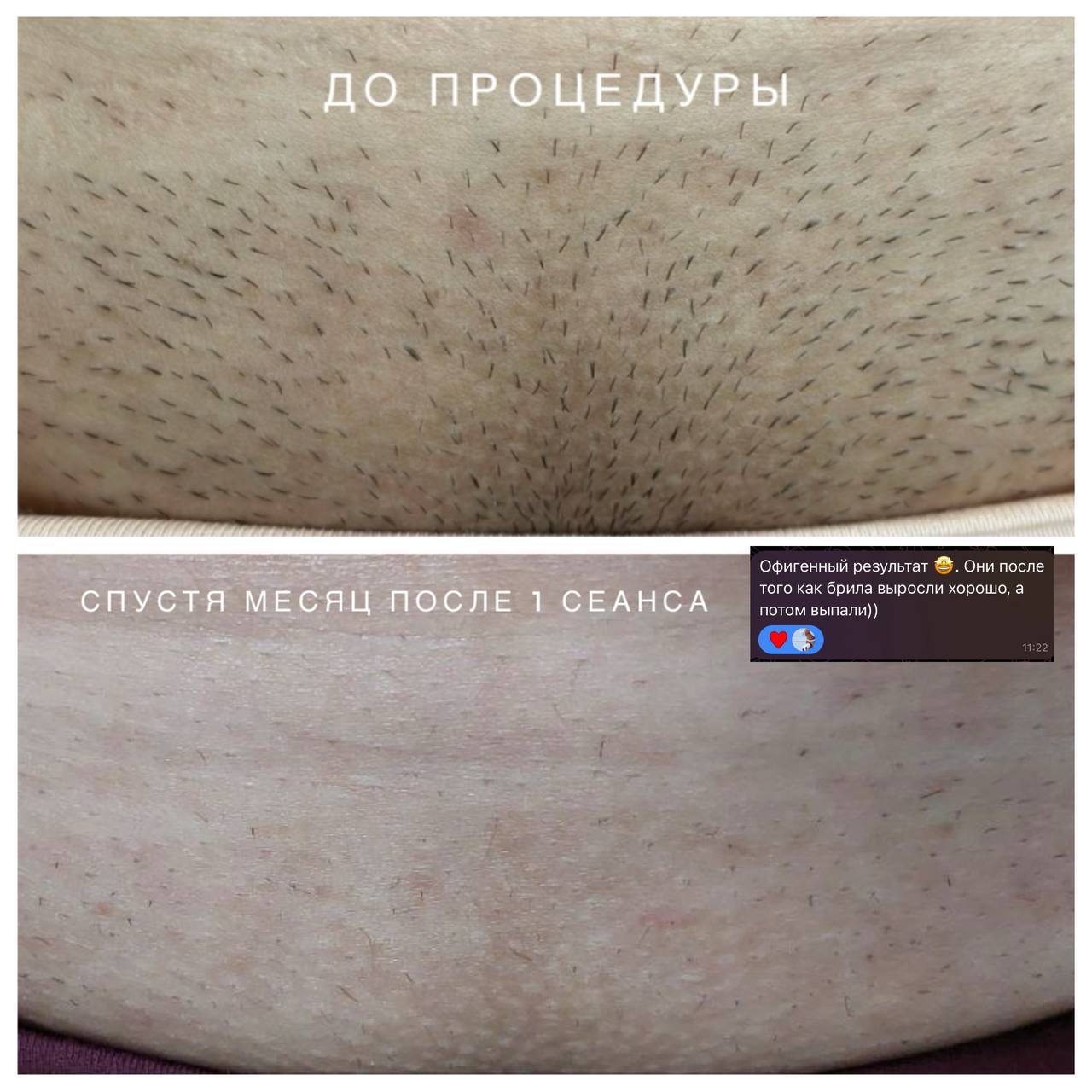 До и после процедуры в Мусаевы PROFI Балашов
